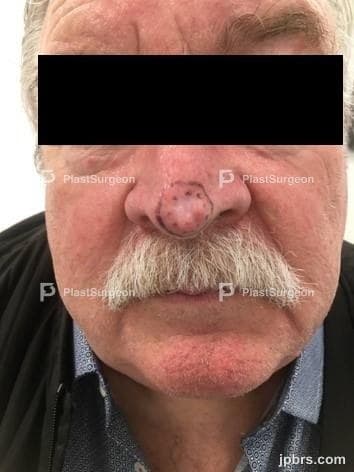Case 13 (2023): Axial frontonasal flap for nasal tip reconstruction after BCC excision