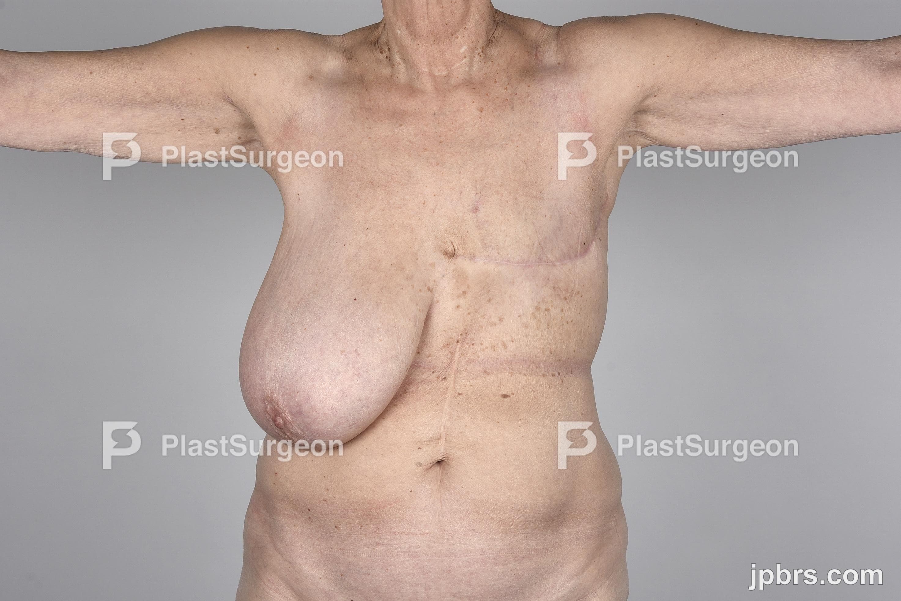 Case 2 (2023): Brystrekonstruktion med breast sharing-teknik