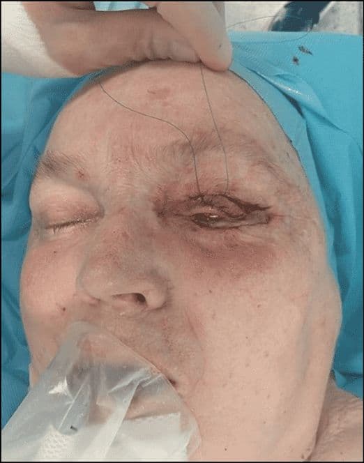 Case 02 2026: Tarsoconjuctival Flap for Eyelid Reconstruction