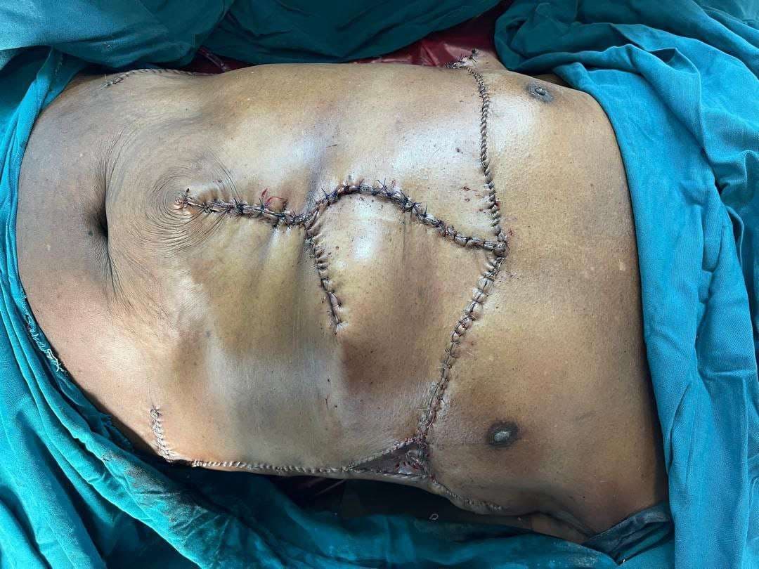 Case 07 2026: Reconstruction of a Complex Epigastric Abdominal Wall Defect Following Wide Excision of Giant Fibrosarcoma Using Prolene mesh and Modified Keystone Flap in a Resource-Limited Setting: A Case Report”