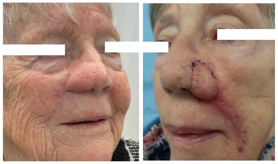 Case 09 2026: Single-Stage Spear Flap Reconstruction of Recurrent Full-Thickness Nasal Alar Defects: A Two-Case Series