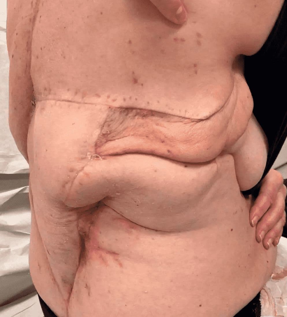 Case 1 - 2025: Lower back reconstruction with free ALT flap, free radial bridge flap and vein graft