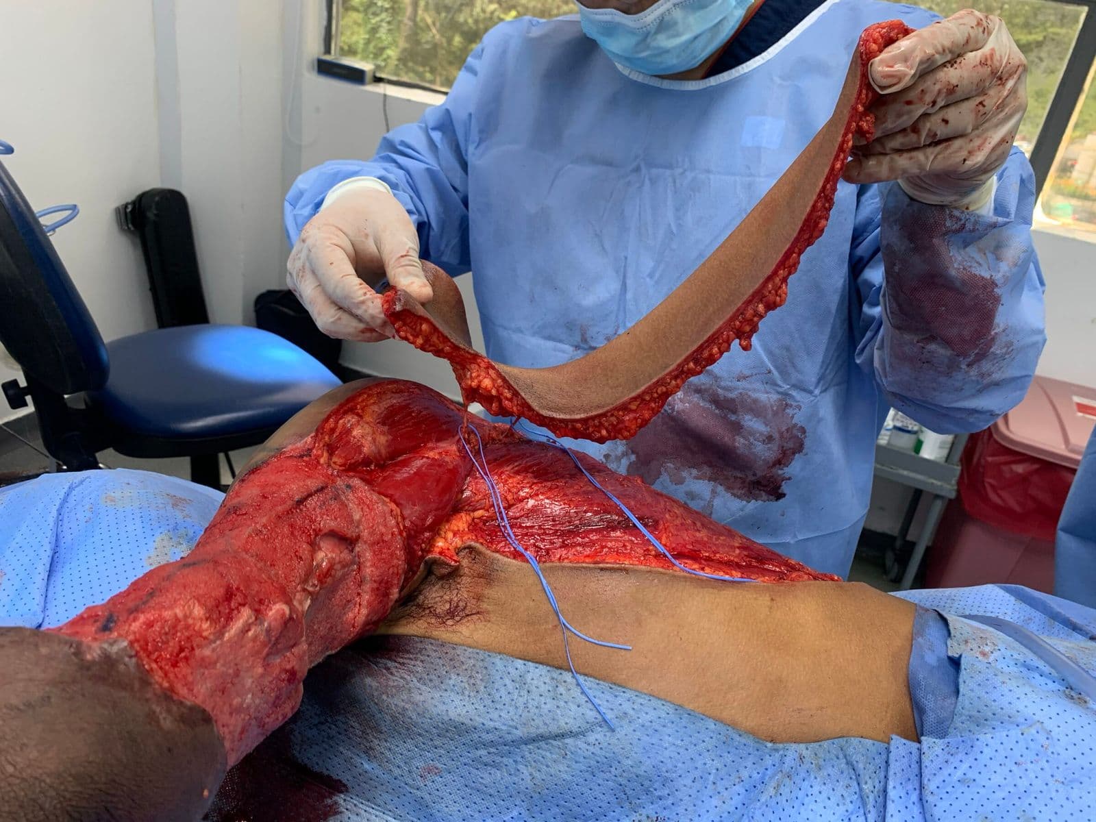 Case 10 2026: Propeller Flap Based on Two Perforators of the Scapular Artery for the Management of a Severely Traumatized Upper Extremity