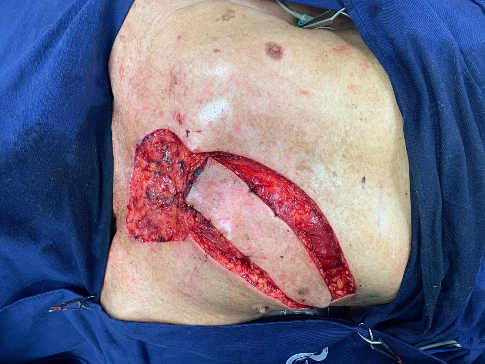 Case 11 2026: Dual Internal Mammary Artery Perforator Propeller Flap for Anterior Chest Wall Reconstruction
