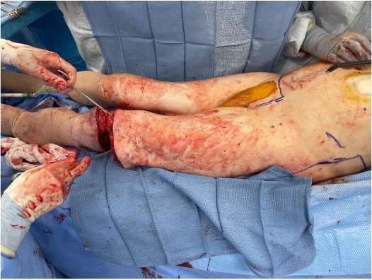 Case 13 2026: Fillet Flap Reconstruction Following Hemicorporectomy for Recurrent High-Grade Gluteal Sarcoma
