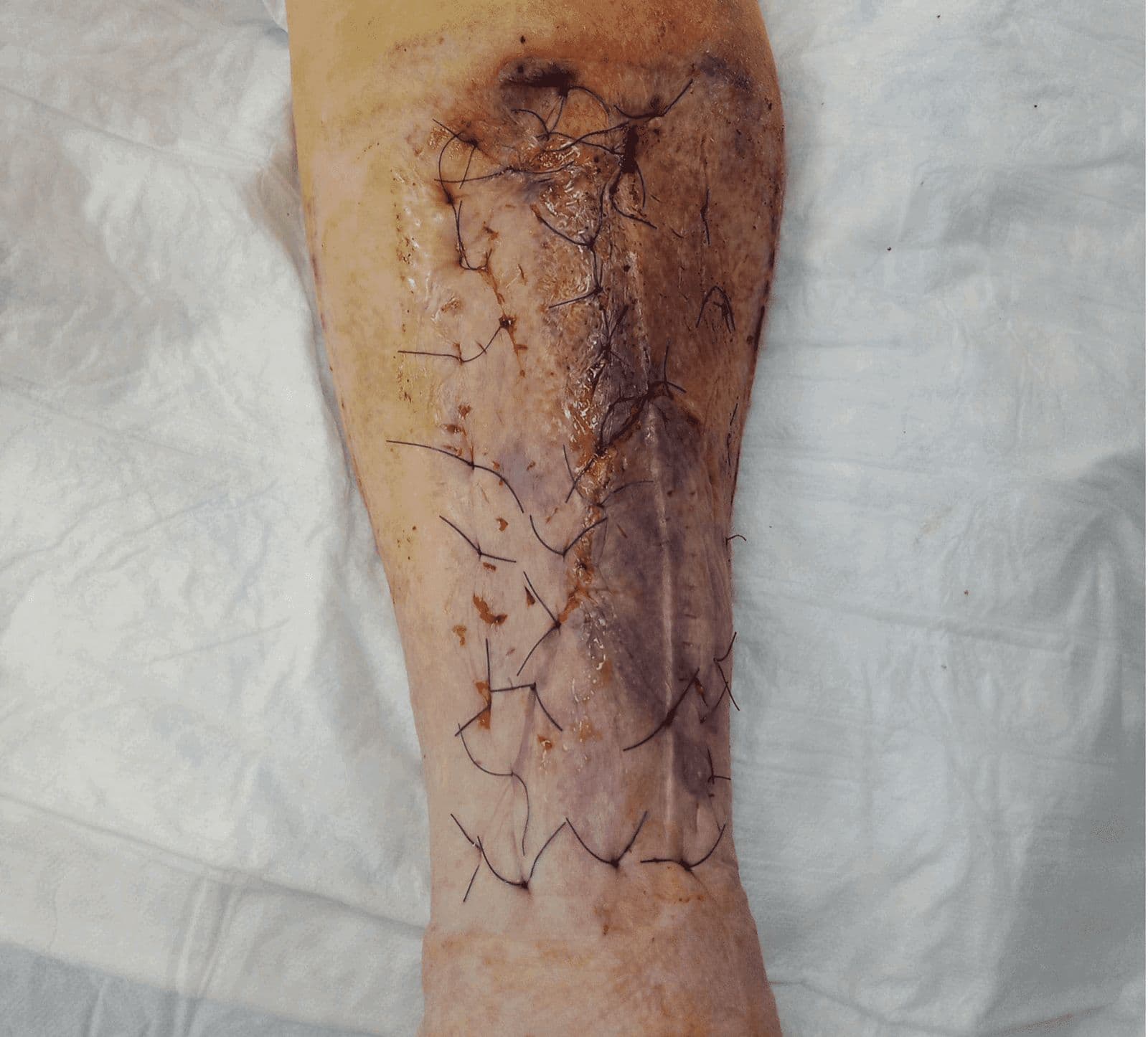 Case 4: Unmasking the Decollement: Timely and Successful Primary Full-Thickness Skin Grafting in Complex Lower Leg Trauma