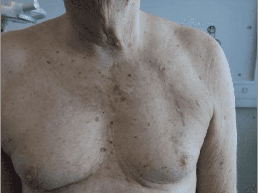 Case 5: Hatchet flap for reconstruction of a defect on the anterior chest wall