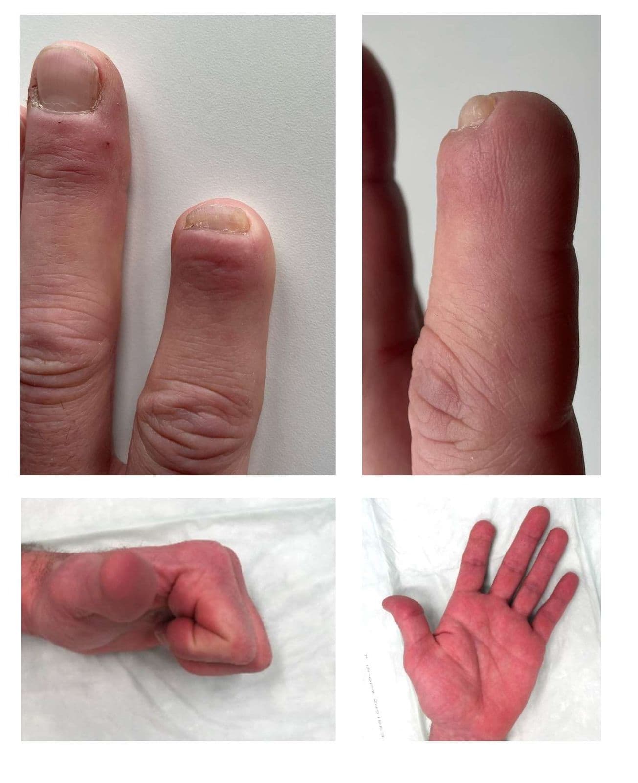 Case 6: Fingertip reconstruction by a V-Y flap and eponychial flap in a patient with fingertip amputation