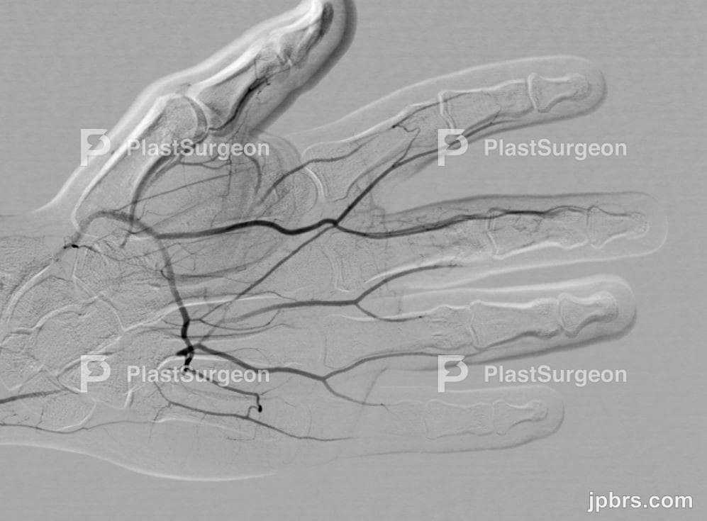 Case 13 (2024): Hypothenar hammer syndrome after minor injury to the hand