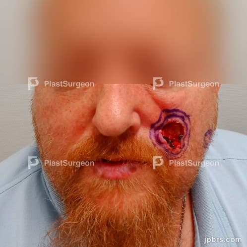 Case 1 (2023): Left Cheek Reconstruction with Combined VY- and Transposition Flap