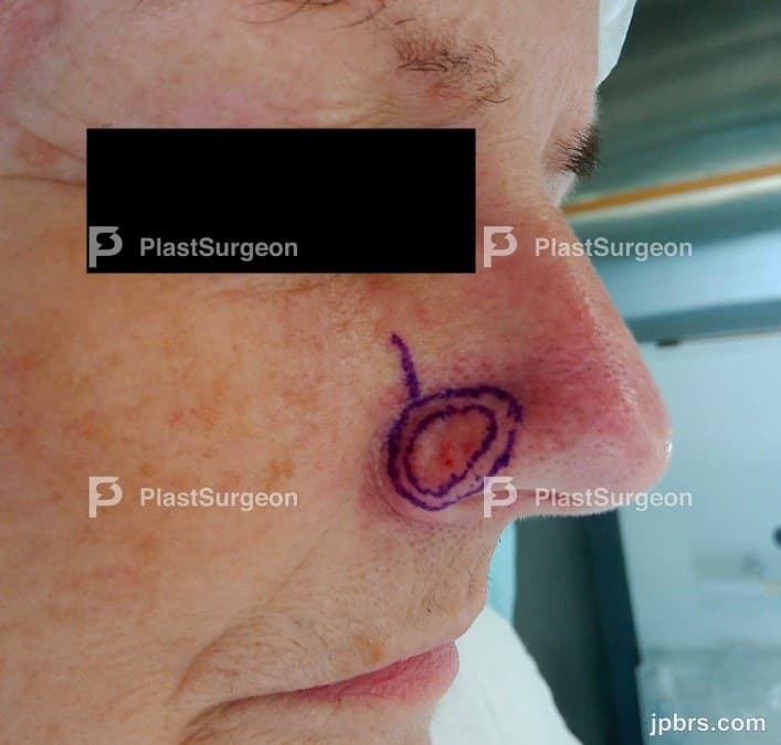Case 8 (2024): Right ala nasi reconstruction with a superior based nasolabial flap