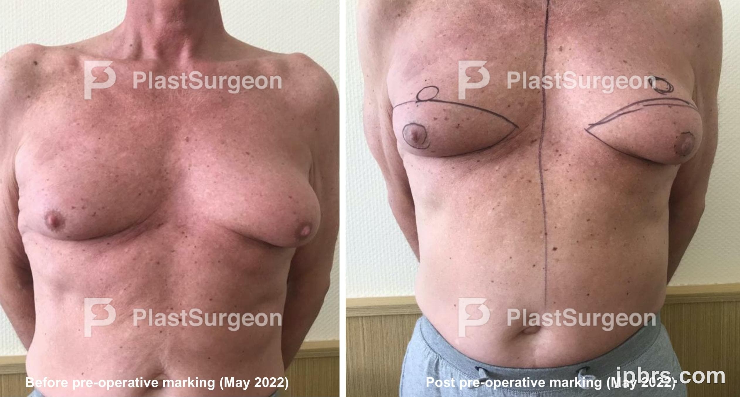 Case 17 (2023): Surgical treatment of Bicalutamide-induced gynecomastia
